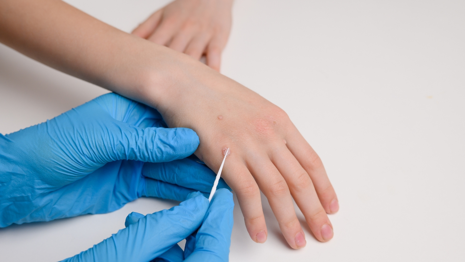 Gloved doctor hands treating warts on patient's hand