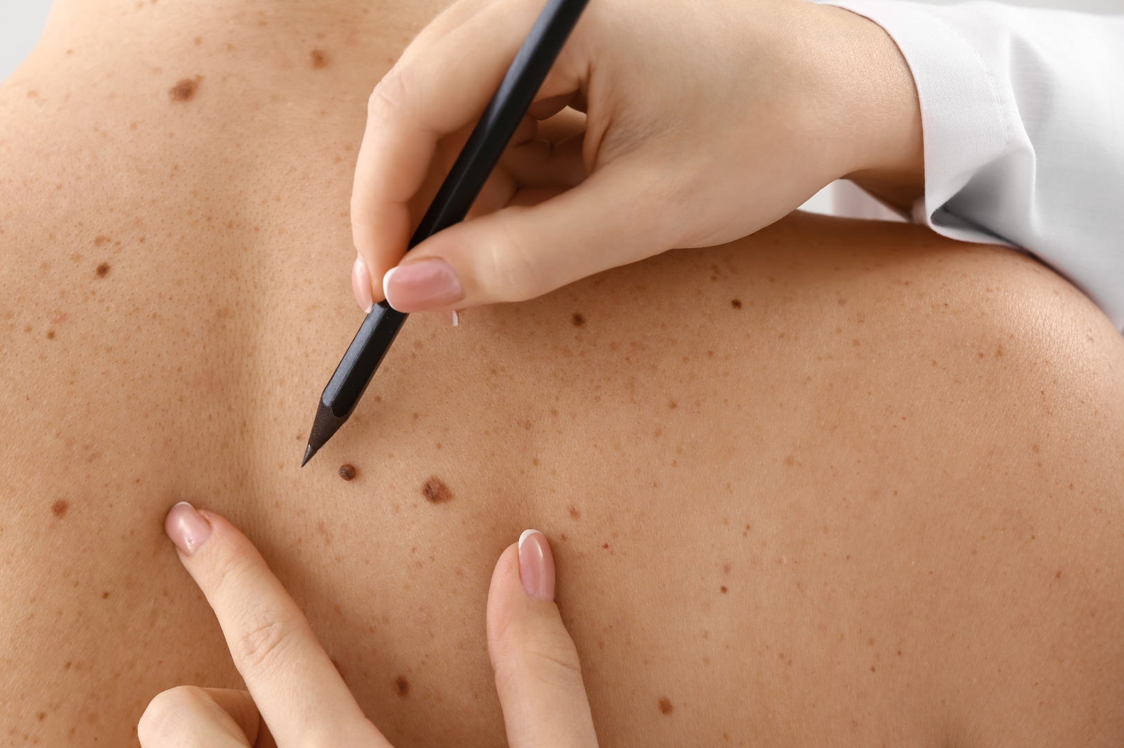 Image of doctor's hand with pencil marking mole on skin