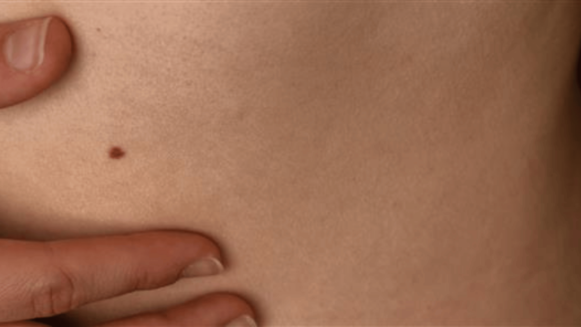 Mole on skin